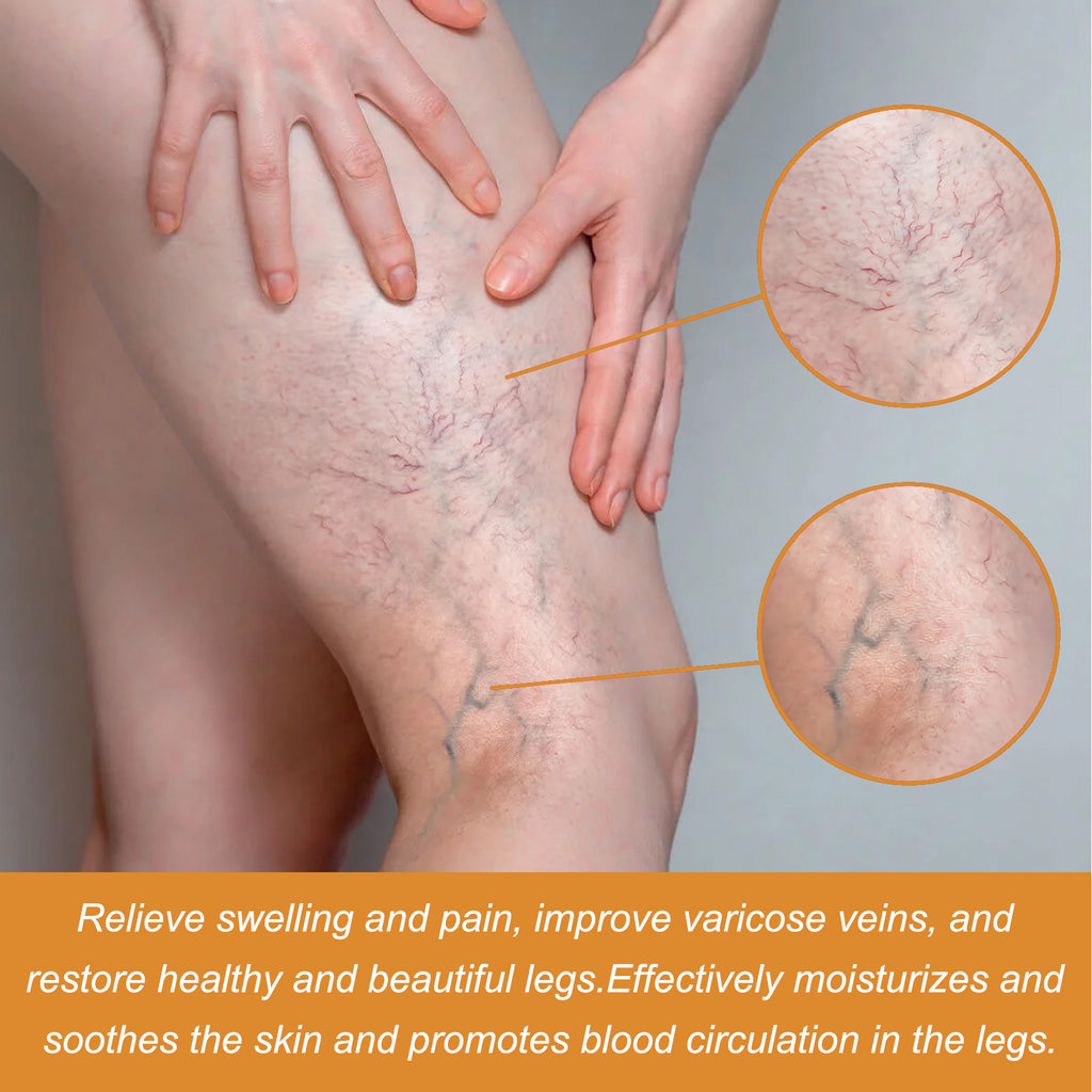 Varicose Veins Health Care Cream / Serum Set (topical leg treatment). Relieve Soreness and Swelling, Flexure, Earthworm Legs, Green Bands, Bulge Repair