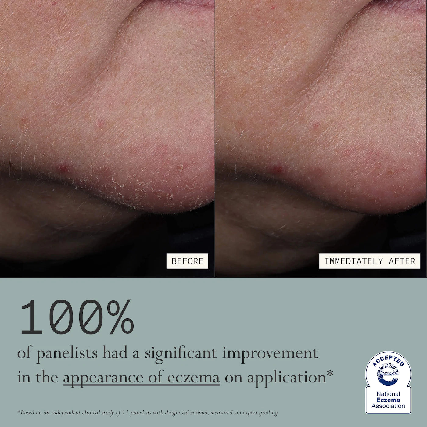Dieux Skin Mercy Intense Recovery Cream – 1% Colloidal Oatmeal for Sensitive & Eczema‑Prone Skin