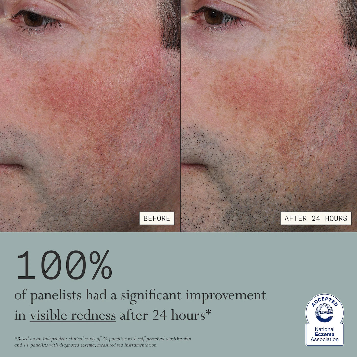 Dieux Skin Mercy Intense Recovery Cream – 1% Colloidal Oatmeal for Sensitive & Eczema‑Prone Skin
