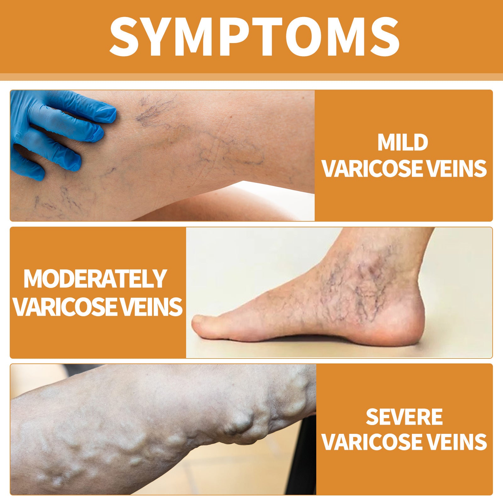 Varicose Veins Health Care Cream / Serum Set (topical leg treatment). Relieve Soreness and Swelling, Flexure, Earthworm Legs, Green Bands, Bulge Repair